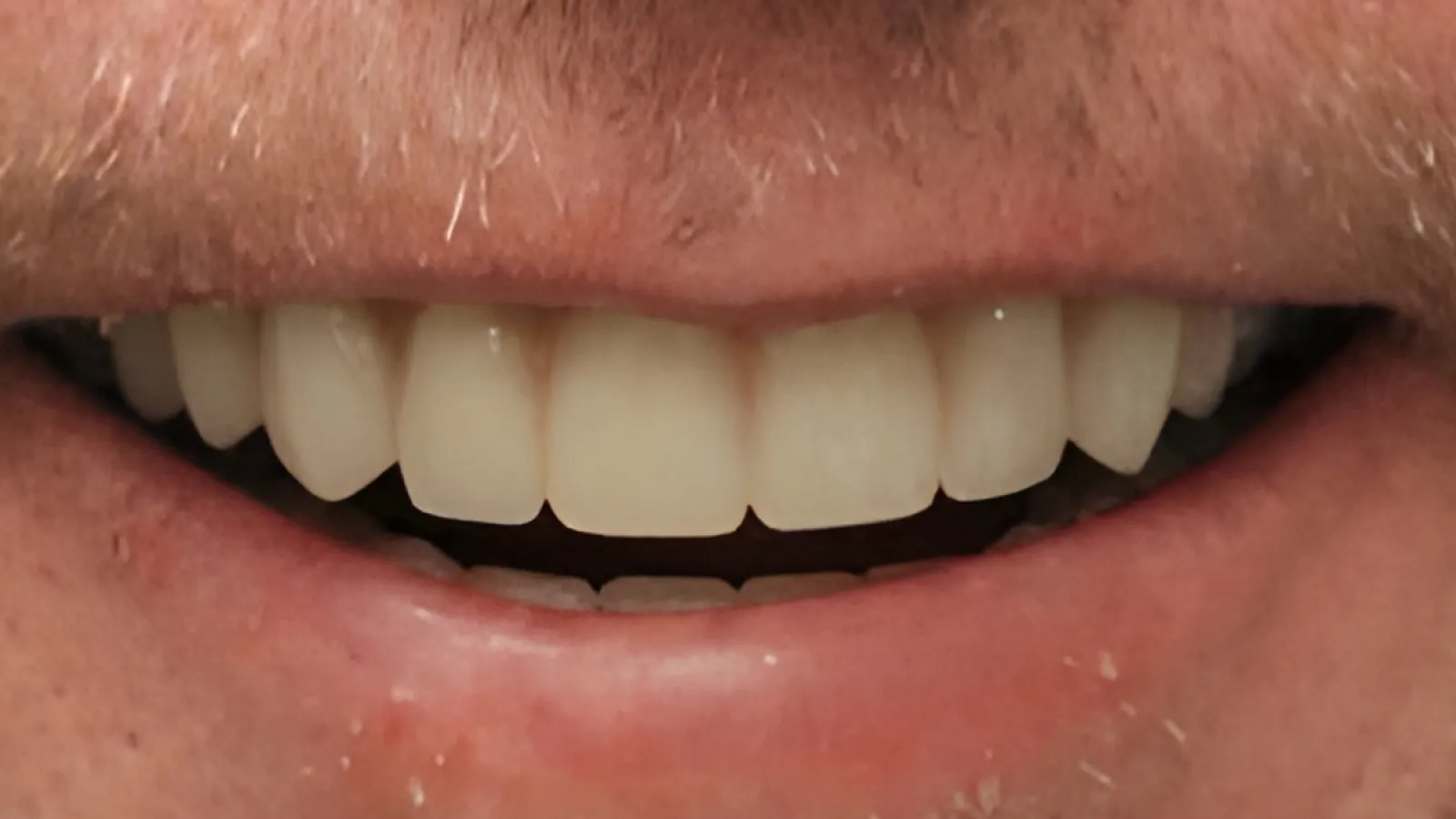Close-up of a smiling mouth showing natural, clean teeth and slightly dry lips with facial hair nearby