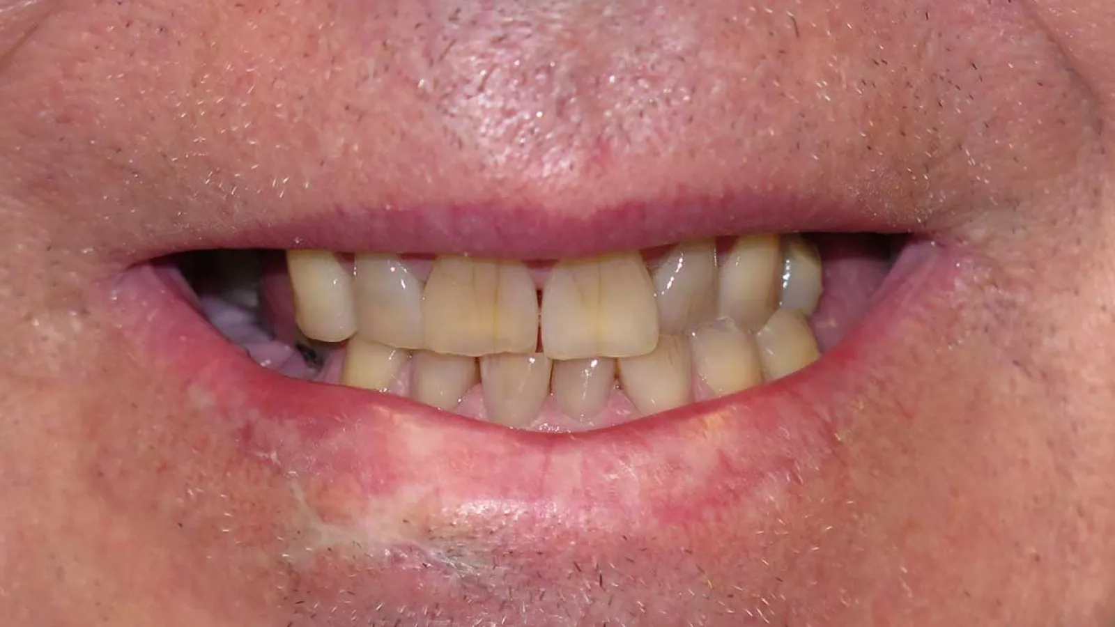 Close-up of a man smiling showing yellowed, uneven, and worn teeth with visible gaps and stained enamel.