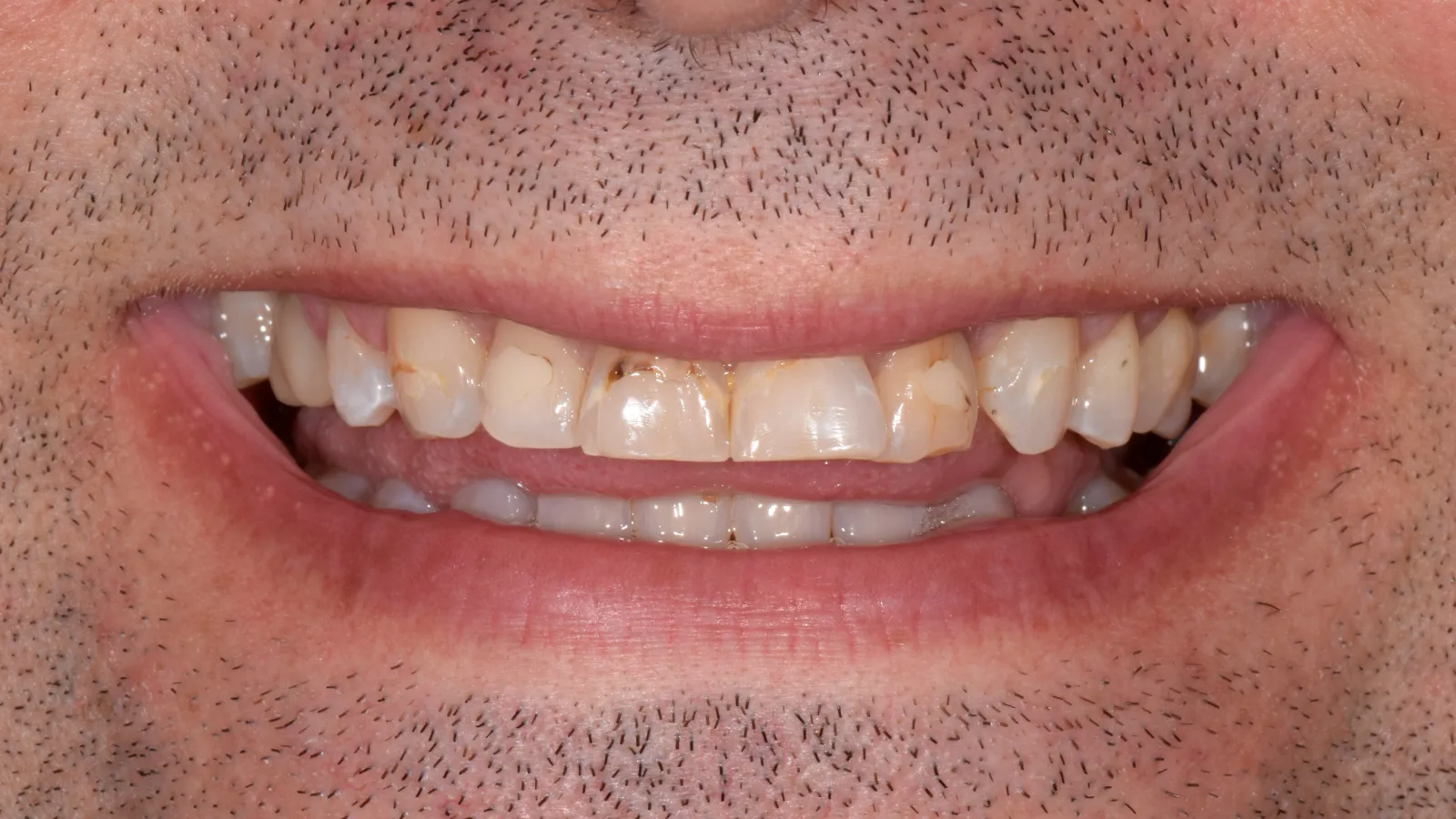 Close-up of a man's mouth with stained, chipped, and misaligned teeth visible in a partial smile.
