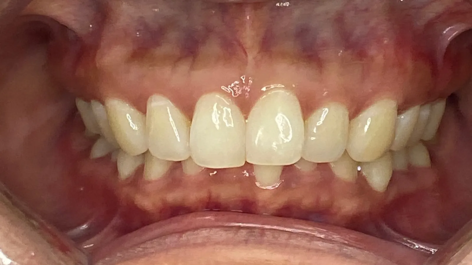 Close-up of a person's teeth showing dental condition with mild crowding and gum detail.