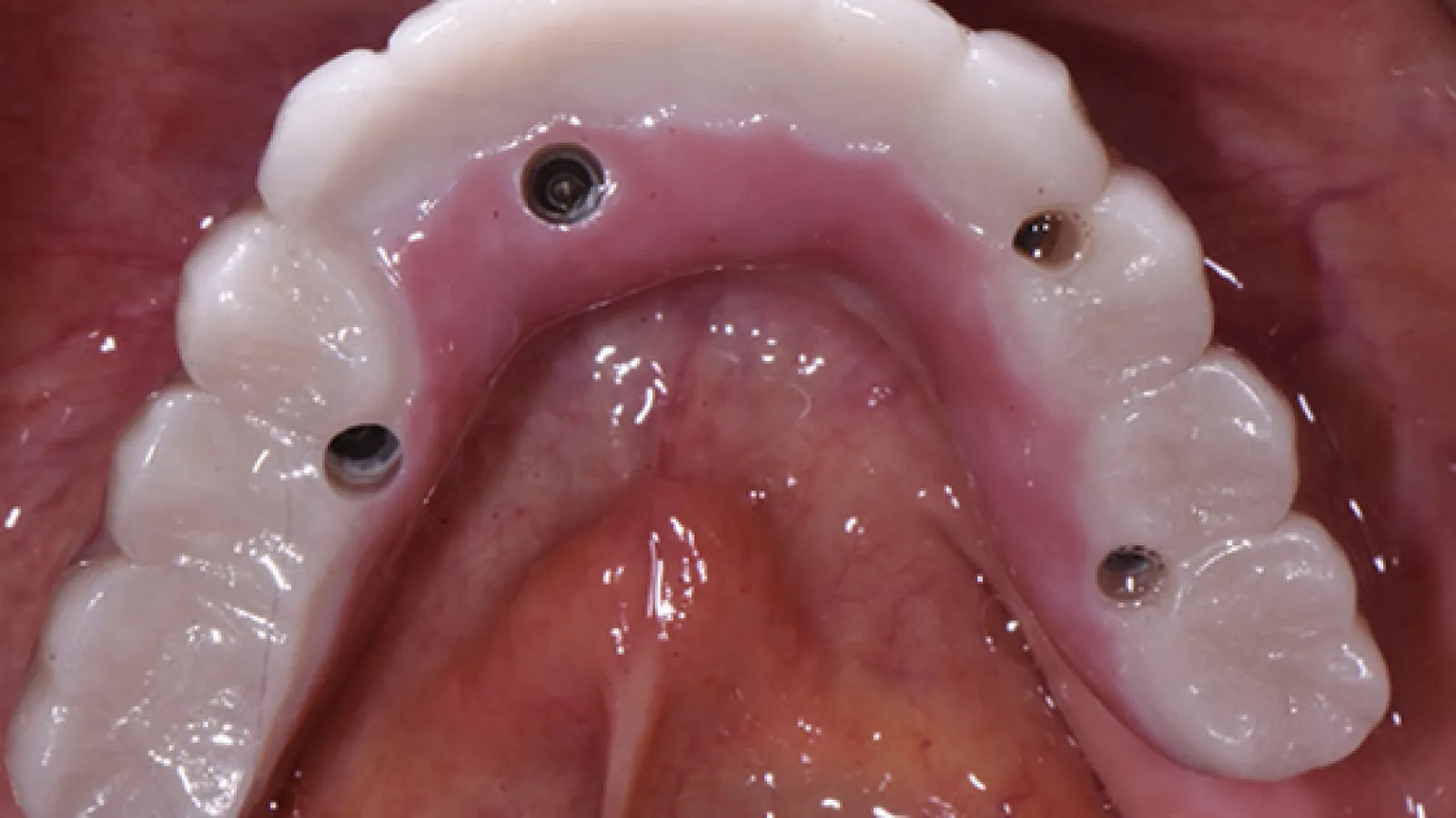Close-up of dental implant-supported prosthesis fitted on upper jaw showing abutment screws and gums