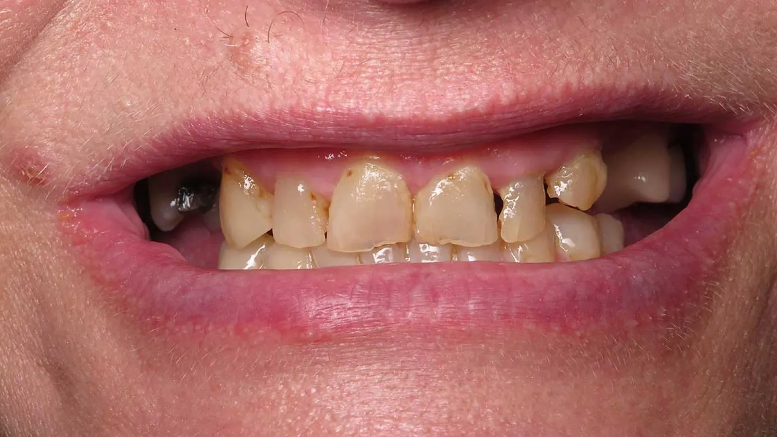 Close-up of a mouth with severely decayed, discolored, and damaged front teeth.