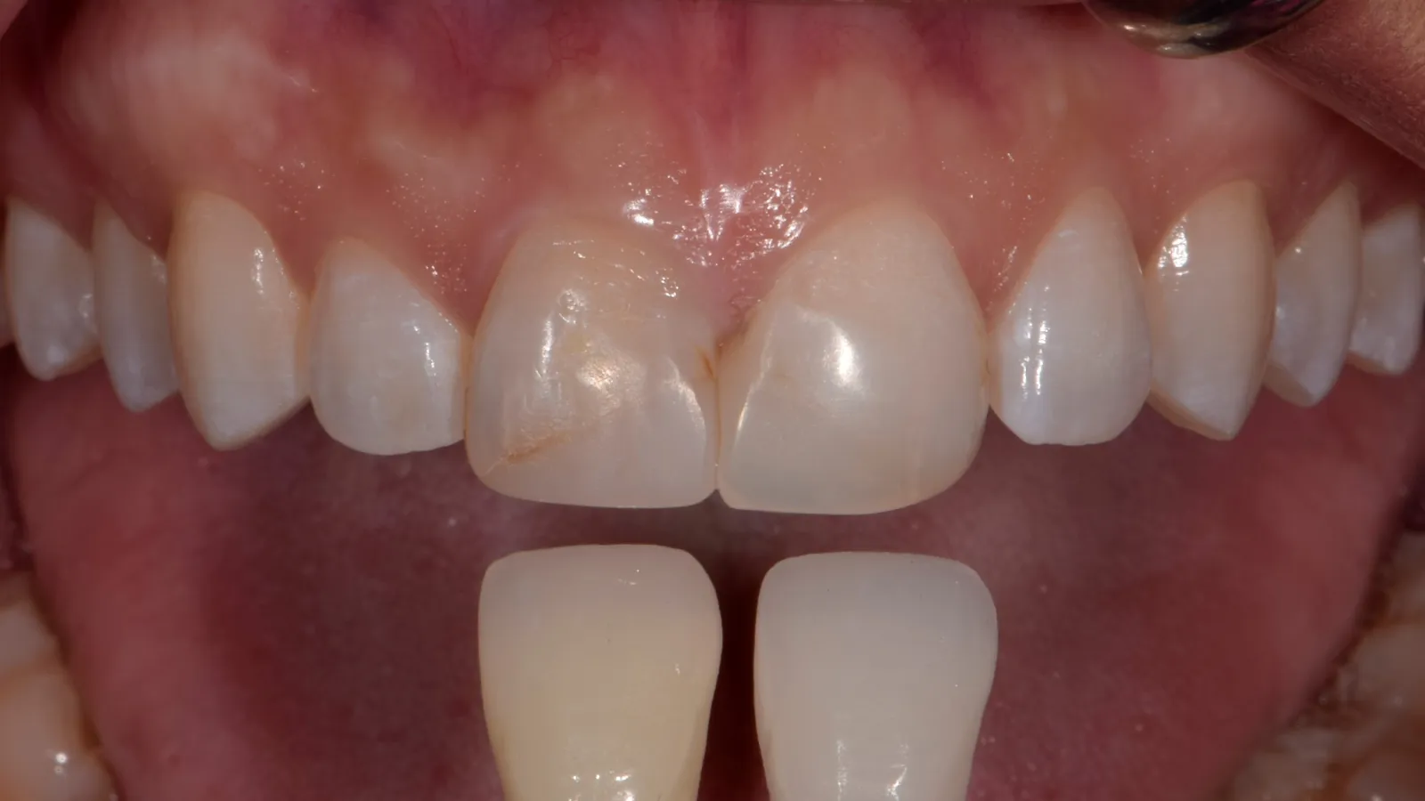 Close-up of upper front teeth showing discoloration and dental shade guide for tooth color matching.