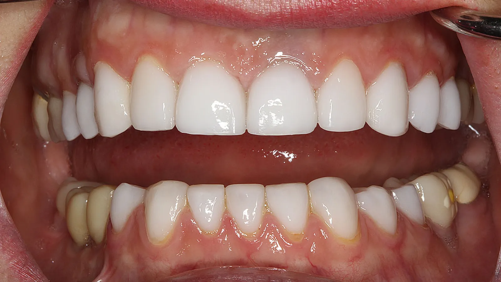 Close-up of an open mouth showing upper dental crowns and natural lower teeth with gum detail.