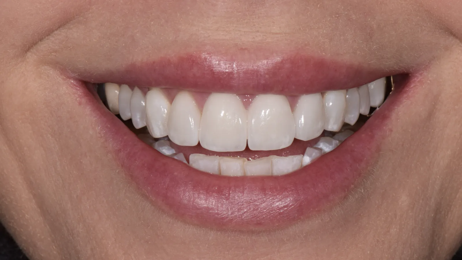 Close-up of a smiling mouth showing clean, white teeth with natural lips and skin texture.