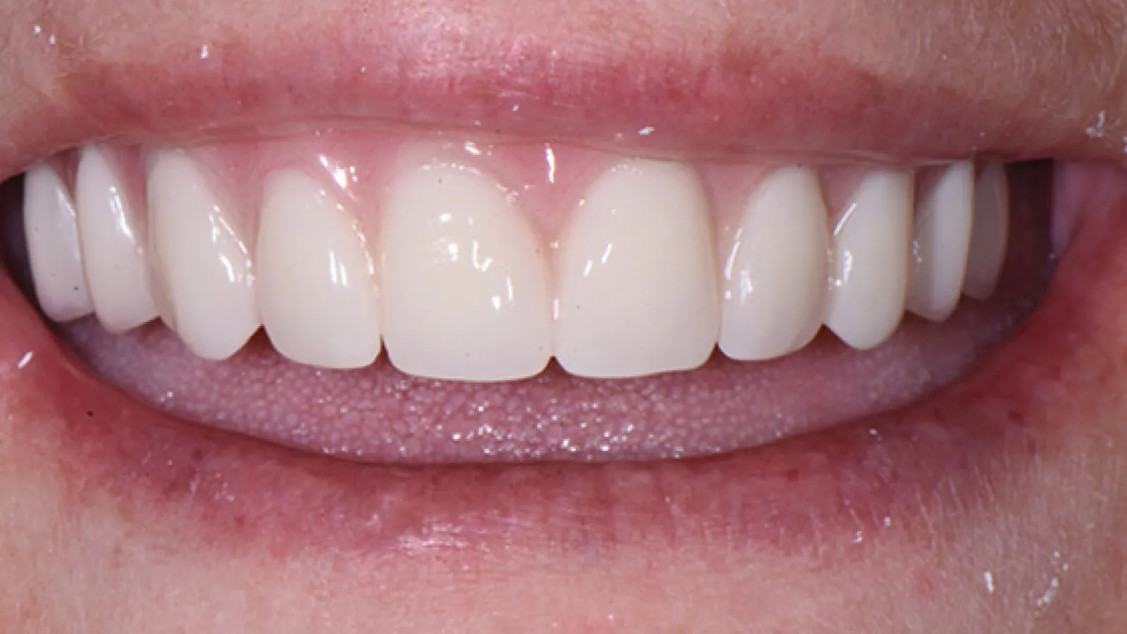 Close-up of a bright, even smile with clean, white teeth and healthy gums
