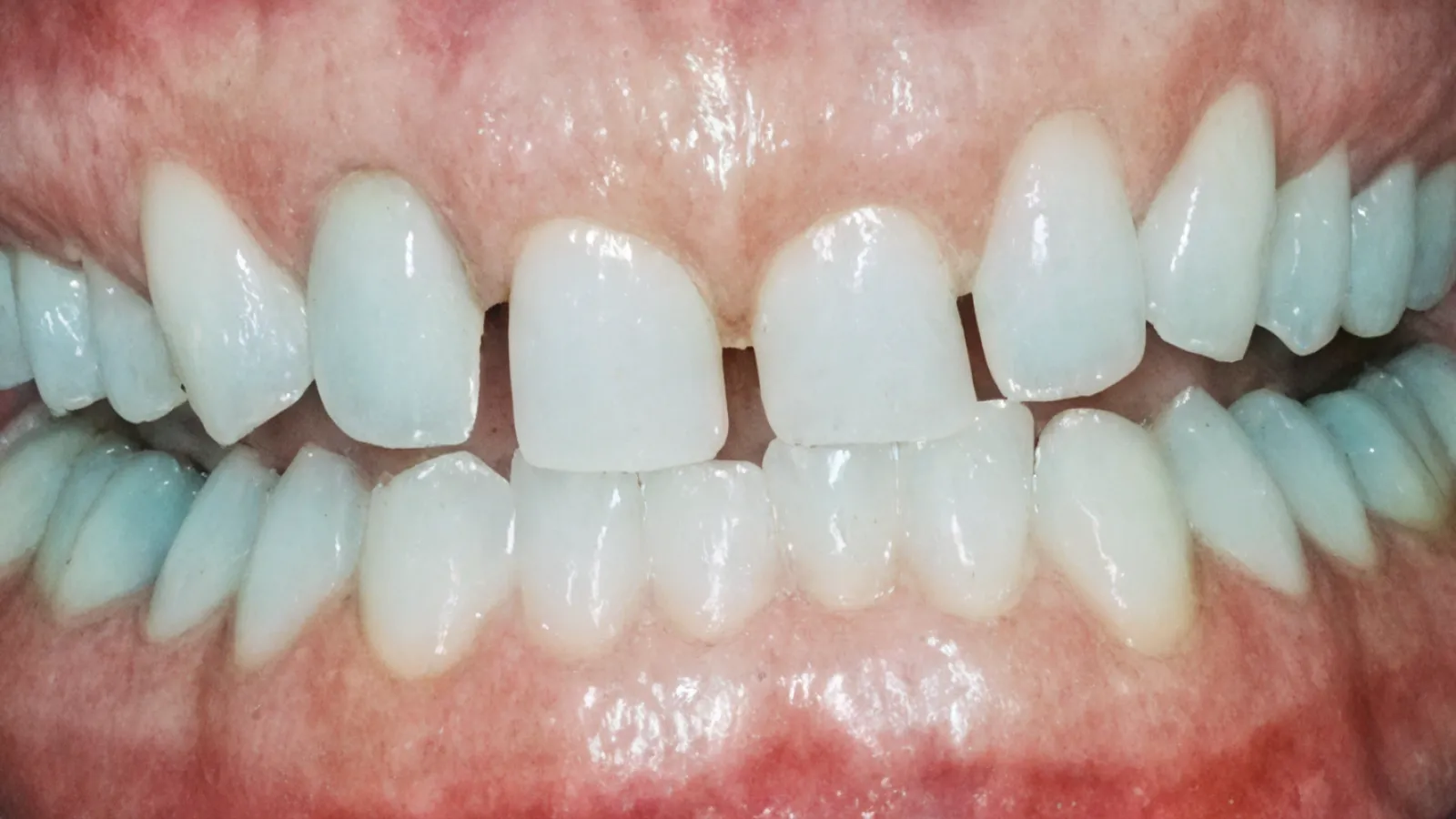 Close-up of human teeth with visible gaps and slight discoloration under natural lighting.