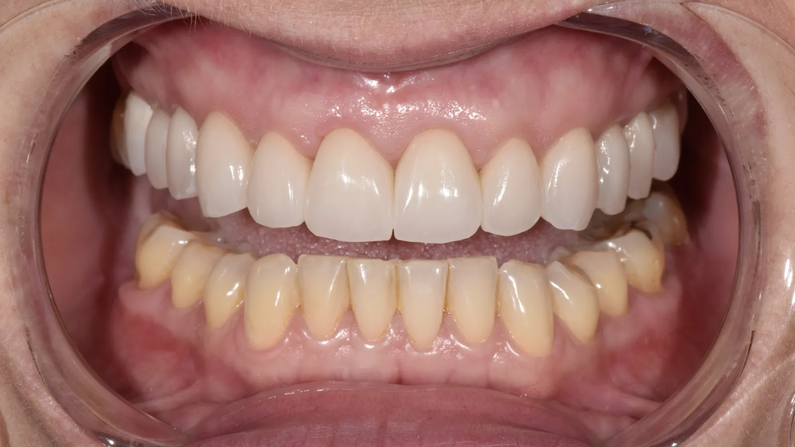 Close-up of a mouth showing white upper dental veneers and natural lower teeth with some discoloration.