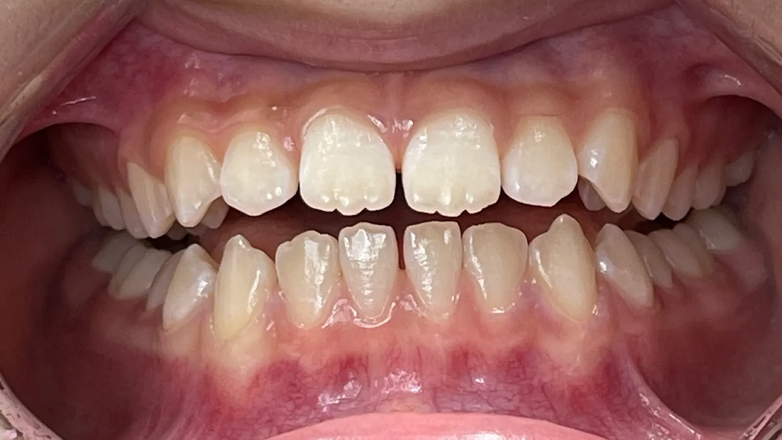 Close-up of misaligned teeth with gaps showing dental crowding and spacing issues in the mouth.