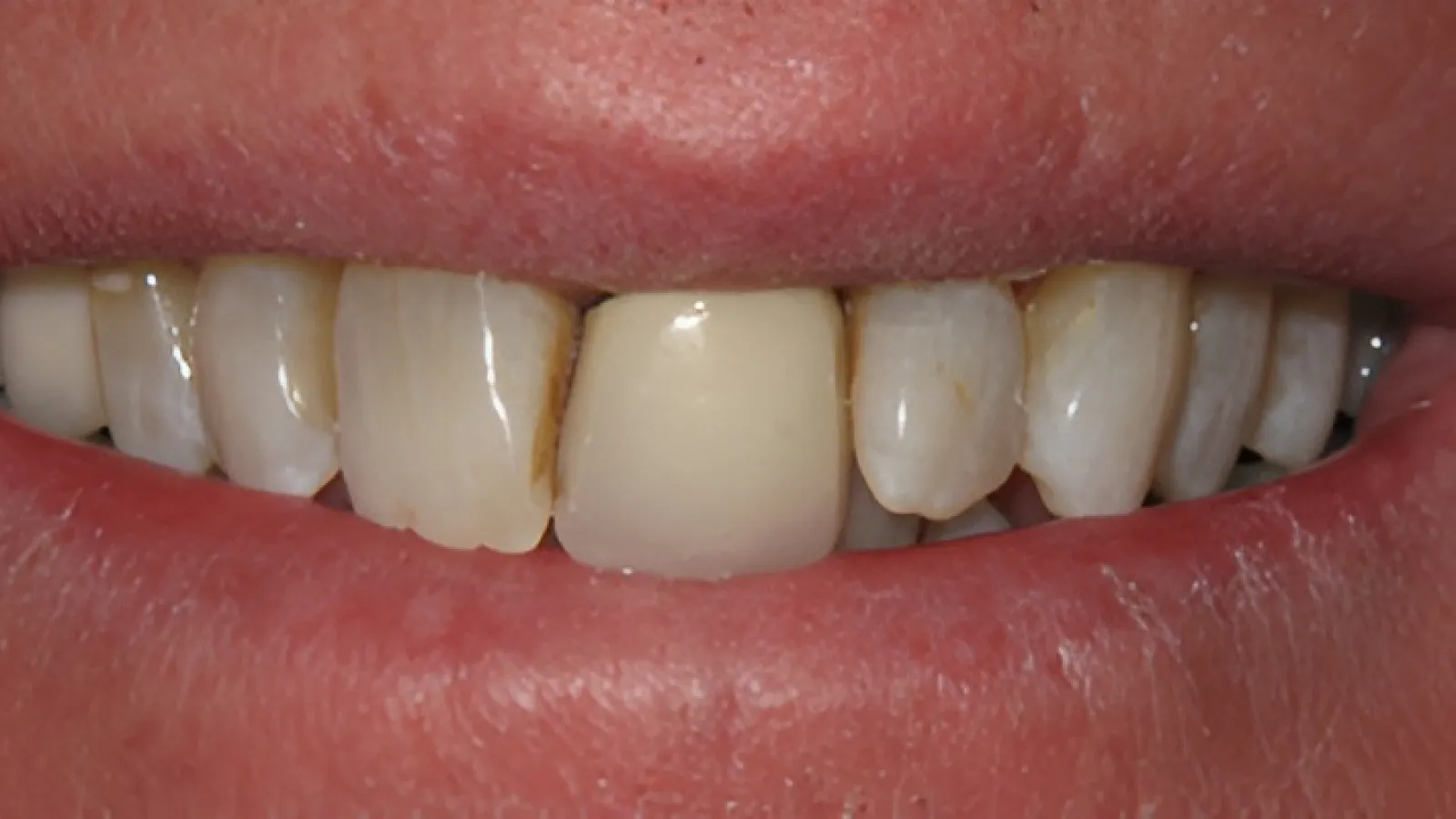 Close-up of human teeth showing discoloration and dental crown on front tooth.