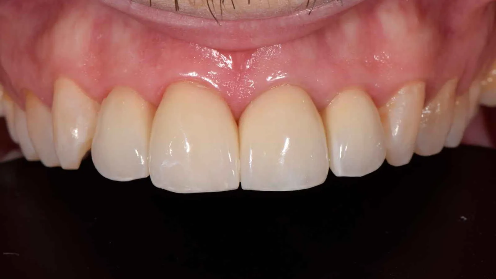 Close-up of healthy upper front teeth and gums with natural color and smooth texture.