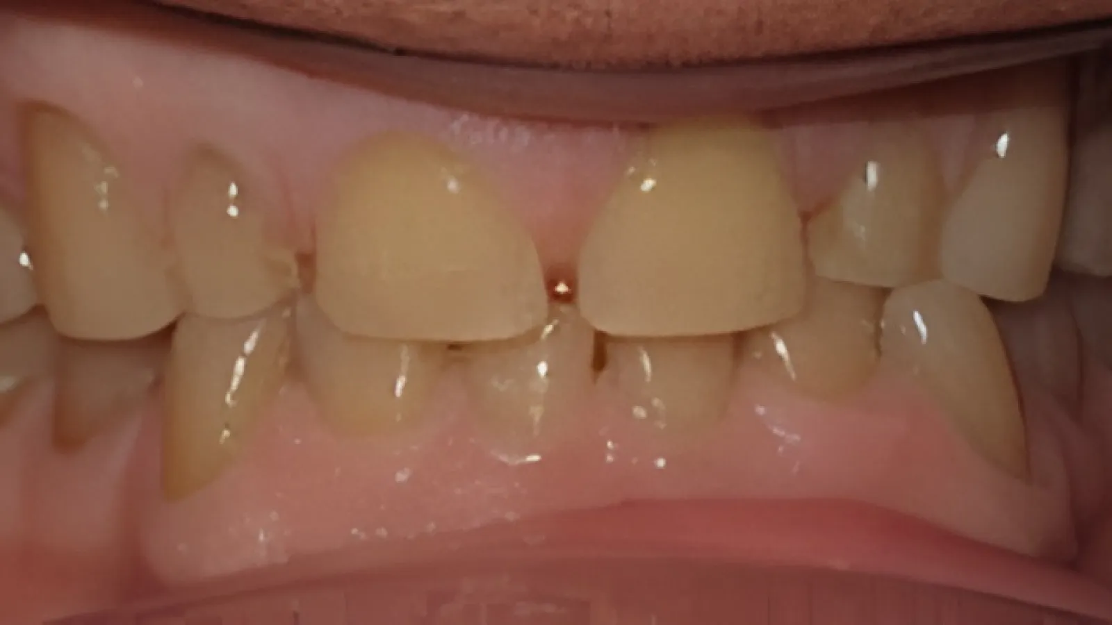 Close-up of uneven, yellowed teeth with gaps and misalignment in upper and lower jaws.
