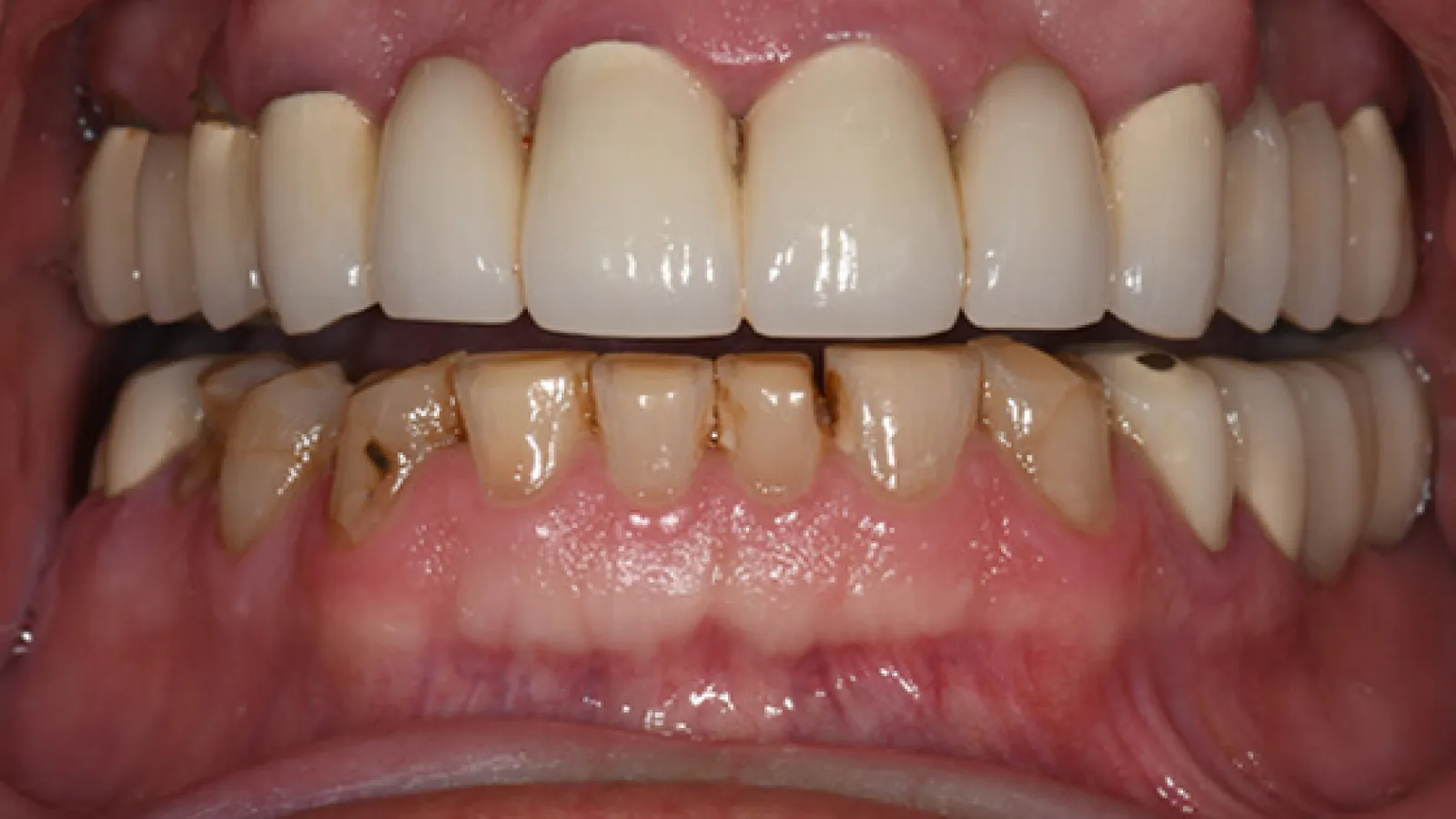 Close-up of upper dental crowns and severely decayed lower front teeth showing dental damage and discoloration
