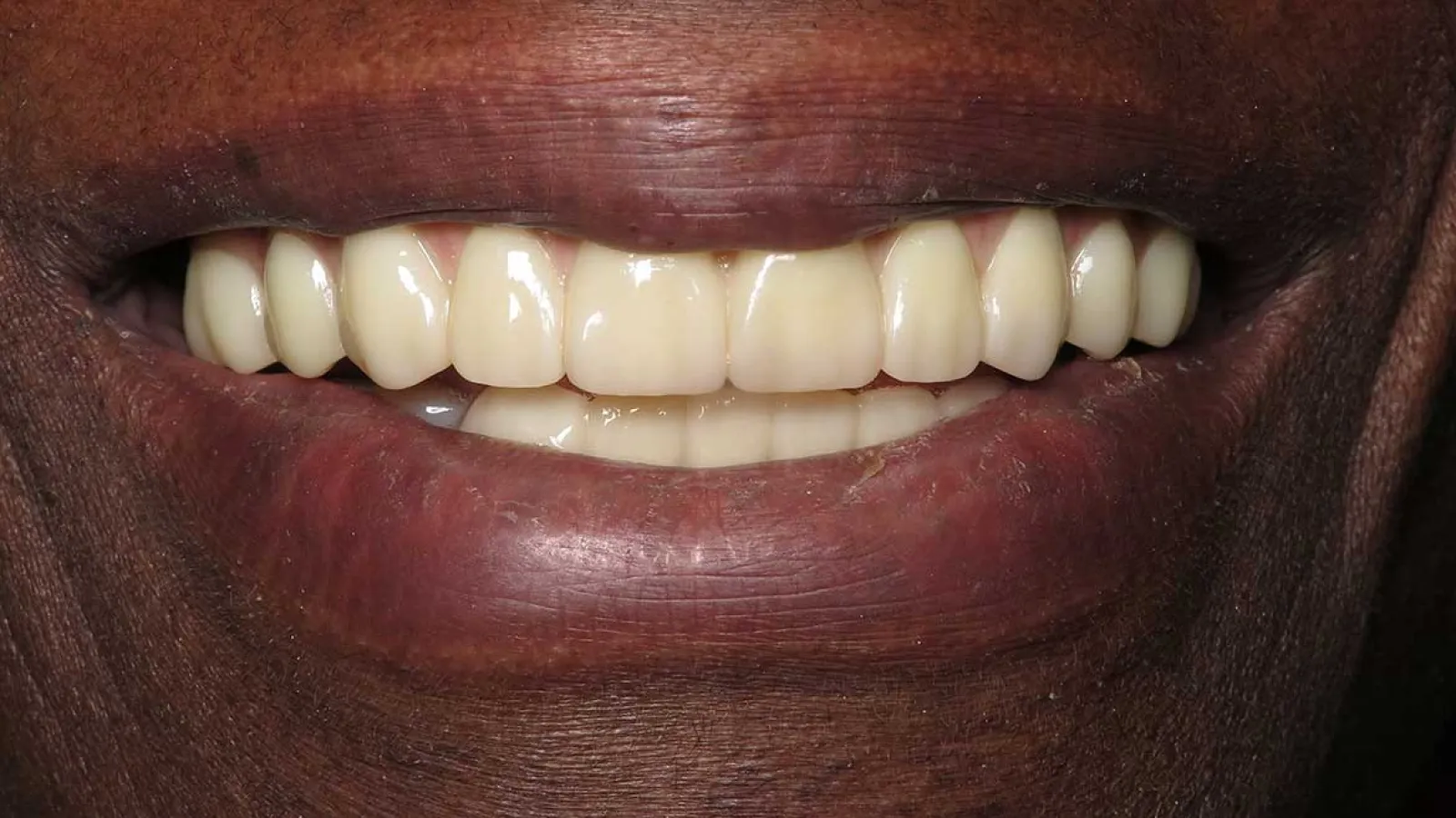 Close-up of a smiling mouth with clean, white teeth and dark skin tone lips.