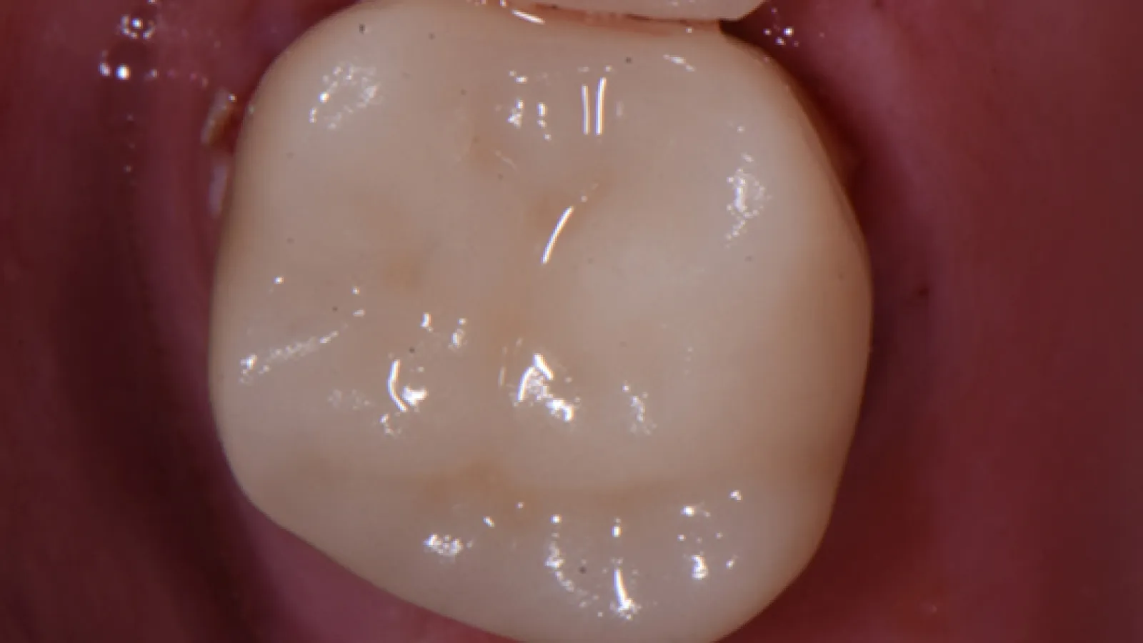 Close-up of a healthy molar tooth with detailed enamel surface in a human mouth.