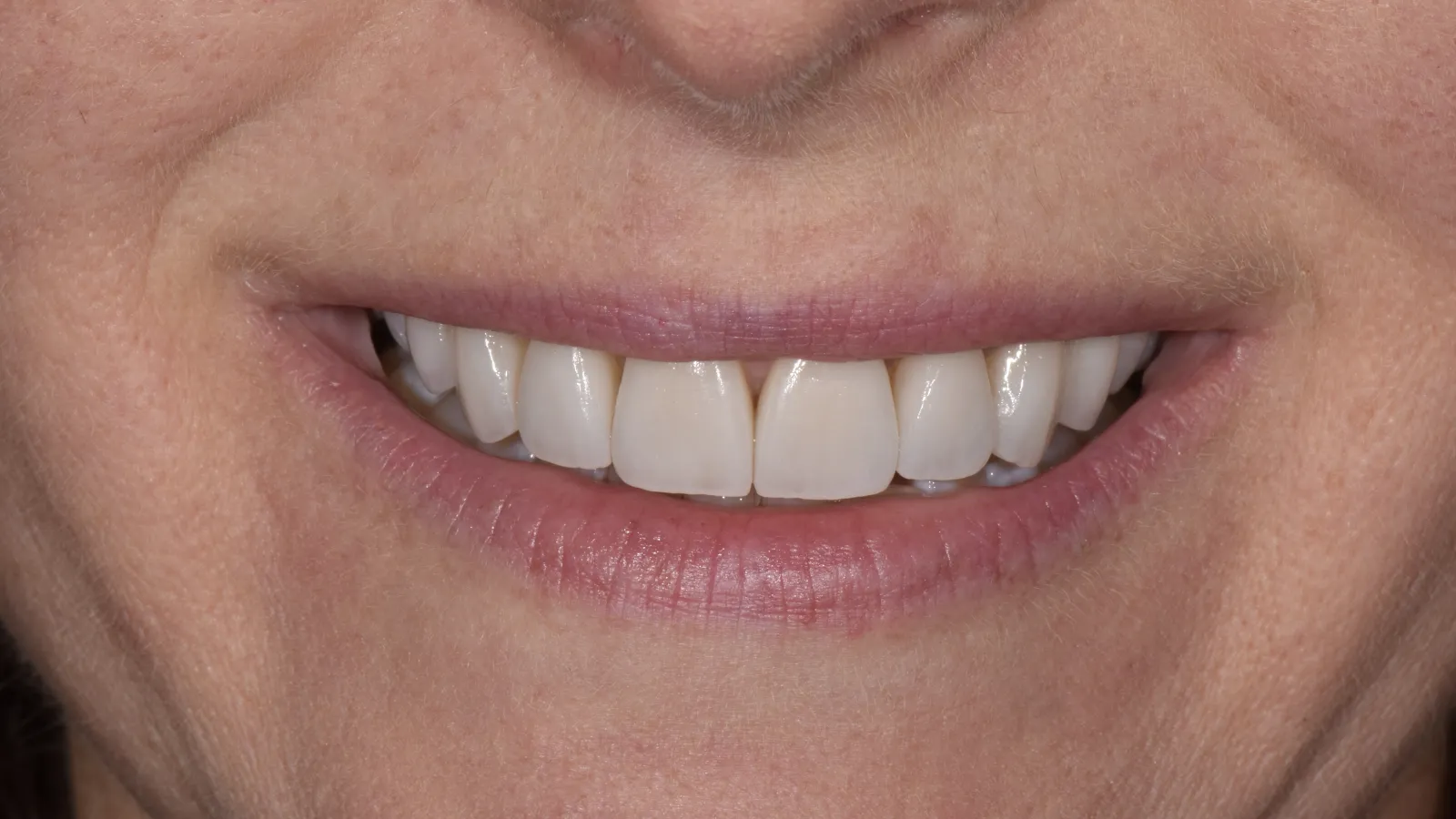 Close-up of a smiling mouth showing clean, white teeth and natural lips on a light skin tone.
