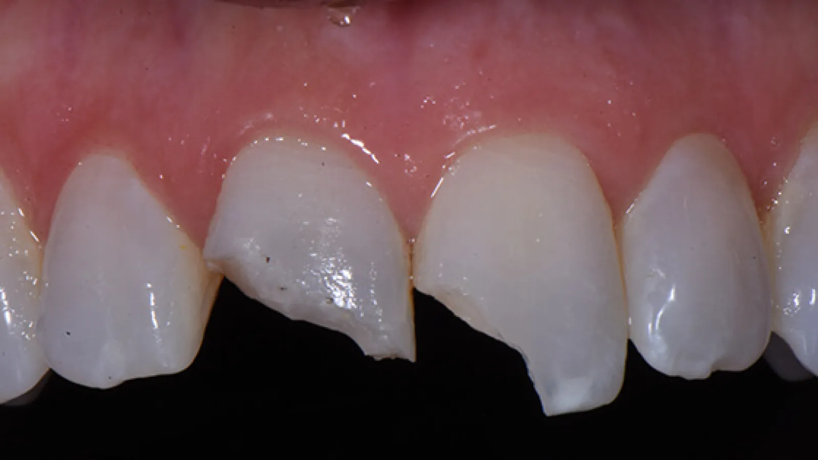 Close-up of upper front teeth showing chipped and damaged incisors with healthy gums.