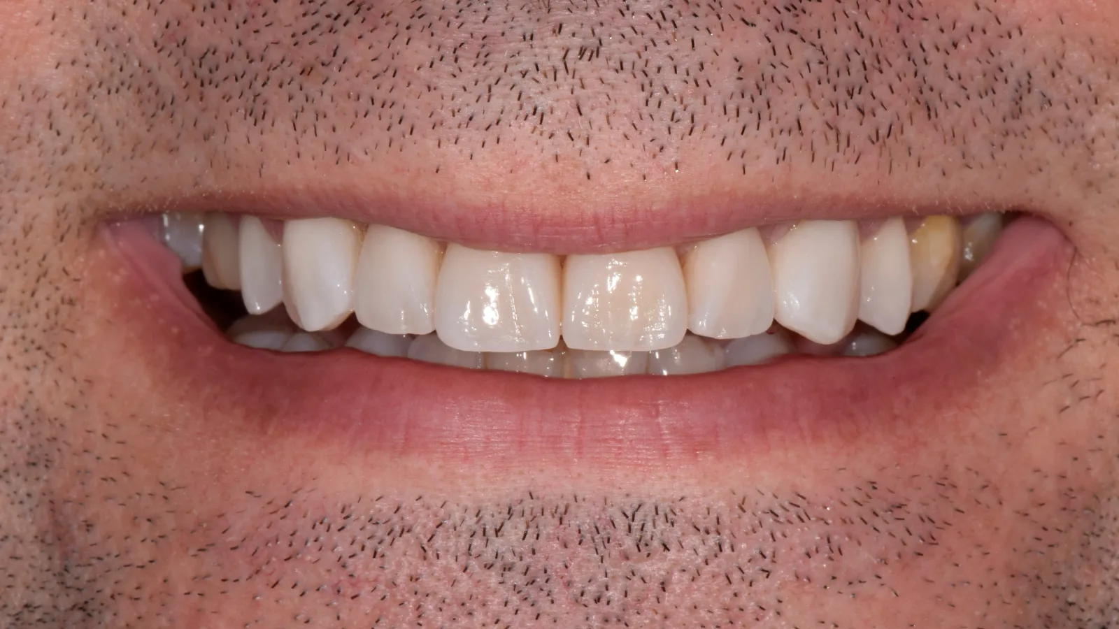 Close-up of a smiling man's mouth showing clean, white teeth with stubble facial hair around lips.