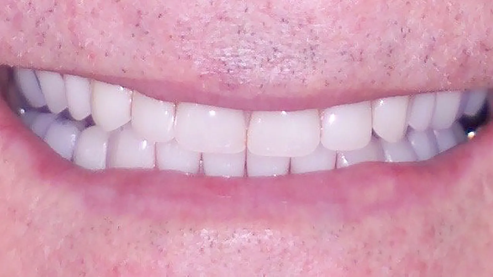 Close-up of a smiling mouth showcasing bright, healthy teeth and gums.