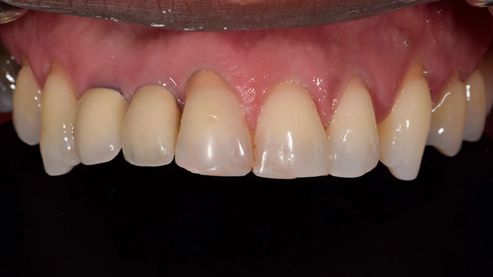 Close-up of upper front teeth showing natural discoloration and gum line against black background