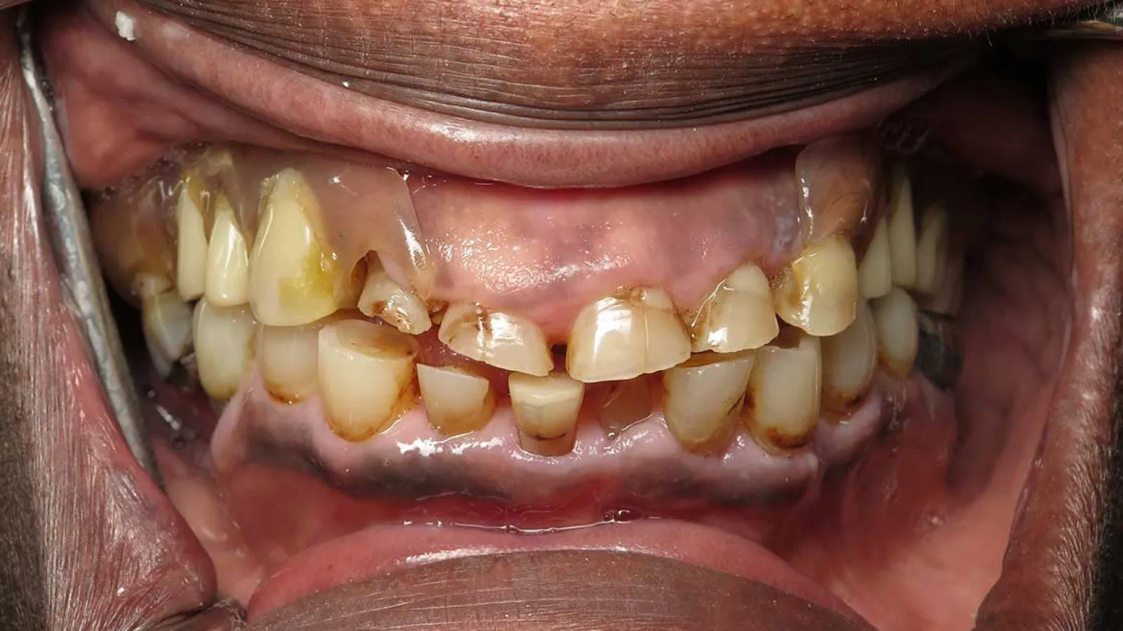 Close-up of severely decayed and broken teeth with stained gums inside a wide-open mouth.