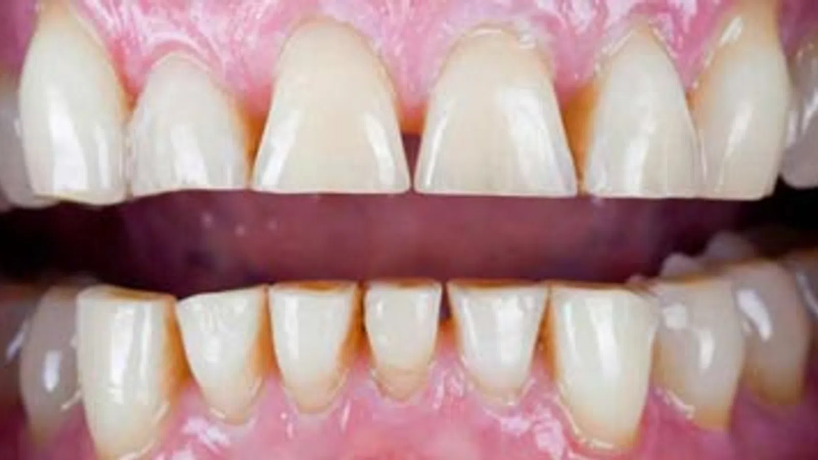 Close-up of open mouth showing upper and lower teeth with gaps and healthy pink gums.