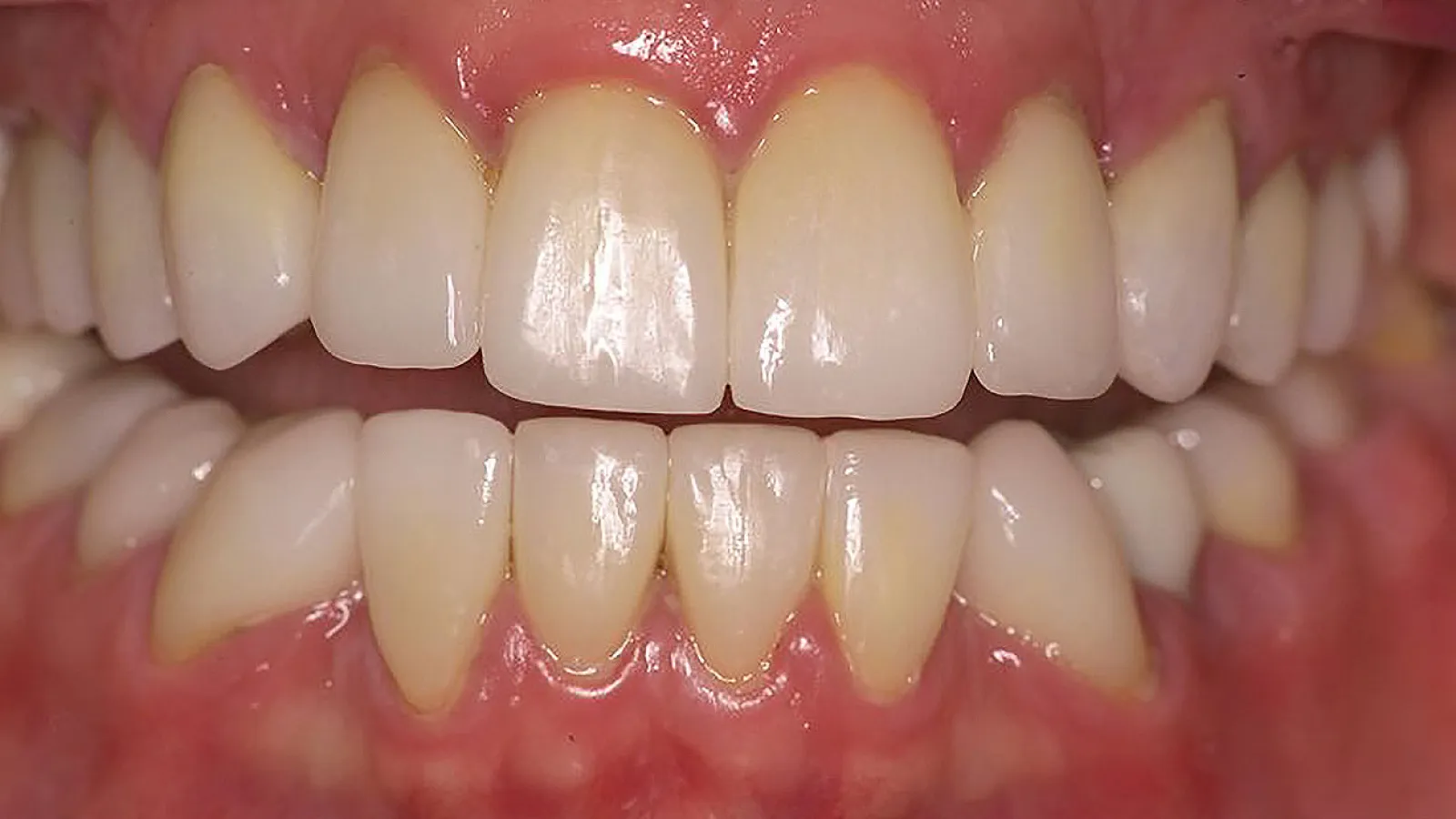 Close-up of healthy teeth, showcasing bright white enamel and aligned gums, emphasizing dental health.