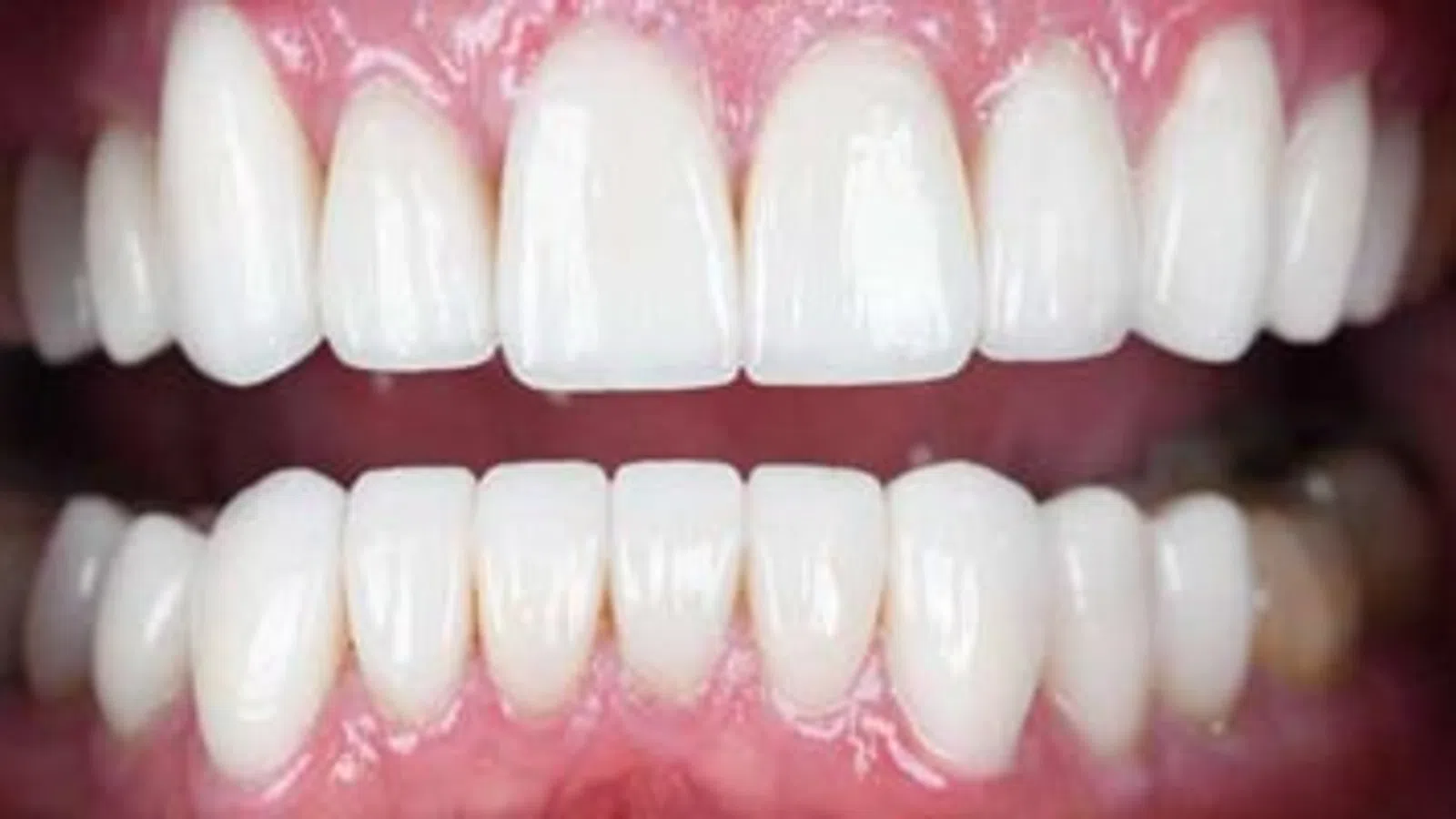 Close-up of healthy, clean upper and lower teeth with pink gums and bright white enamel.