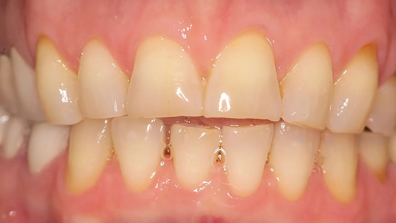 Close-up of healthy human teeth with natural shades and visible gum line, showcasing dental hygiene.