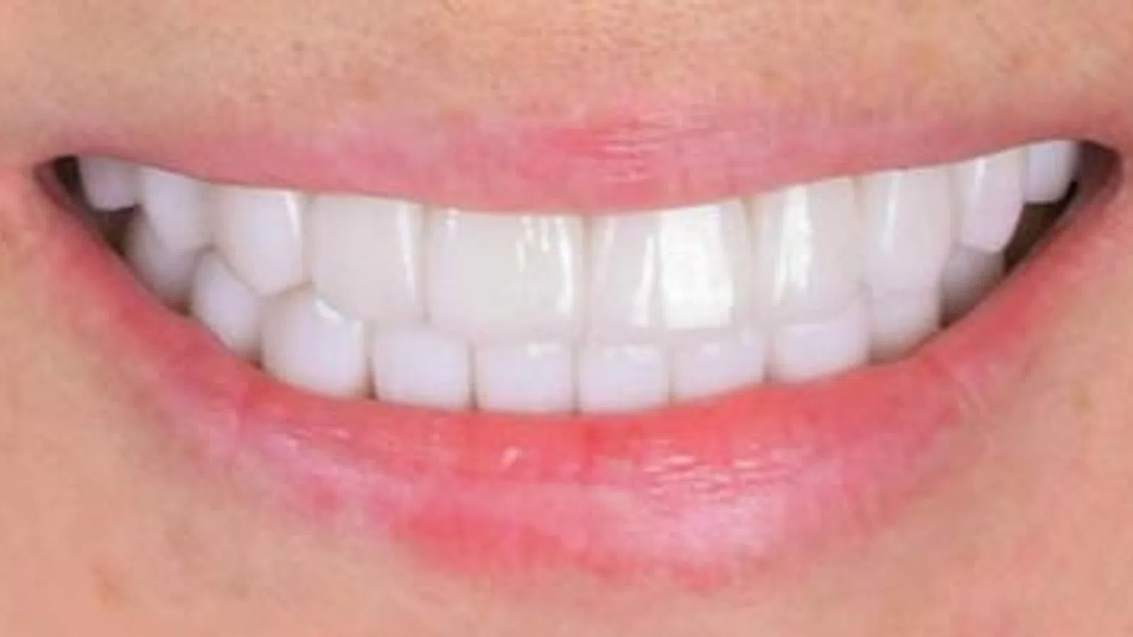 Close-up of bright white teeth with healthy pink lips smiling naturally.