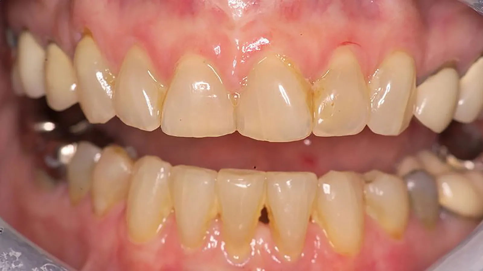 Close-up view of a human mouth showing teeth with plaque and discoloration.