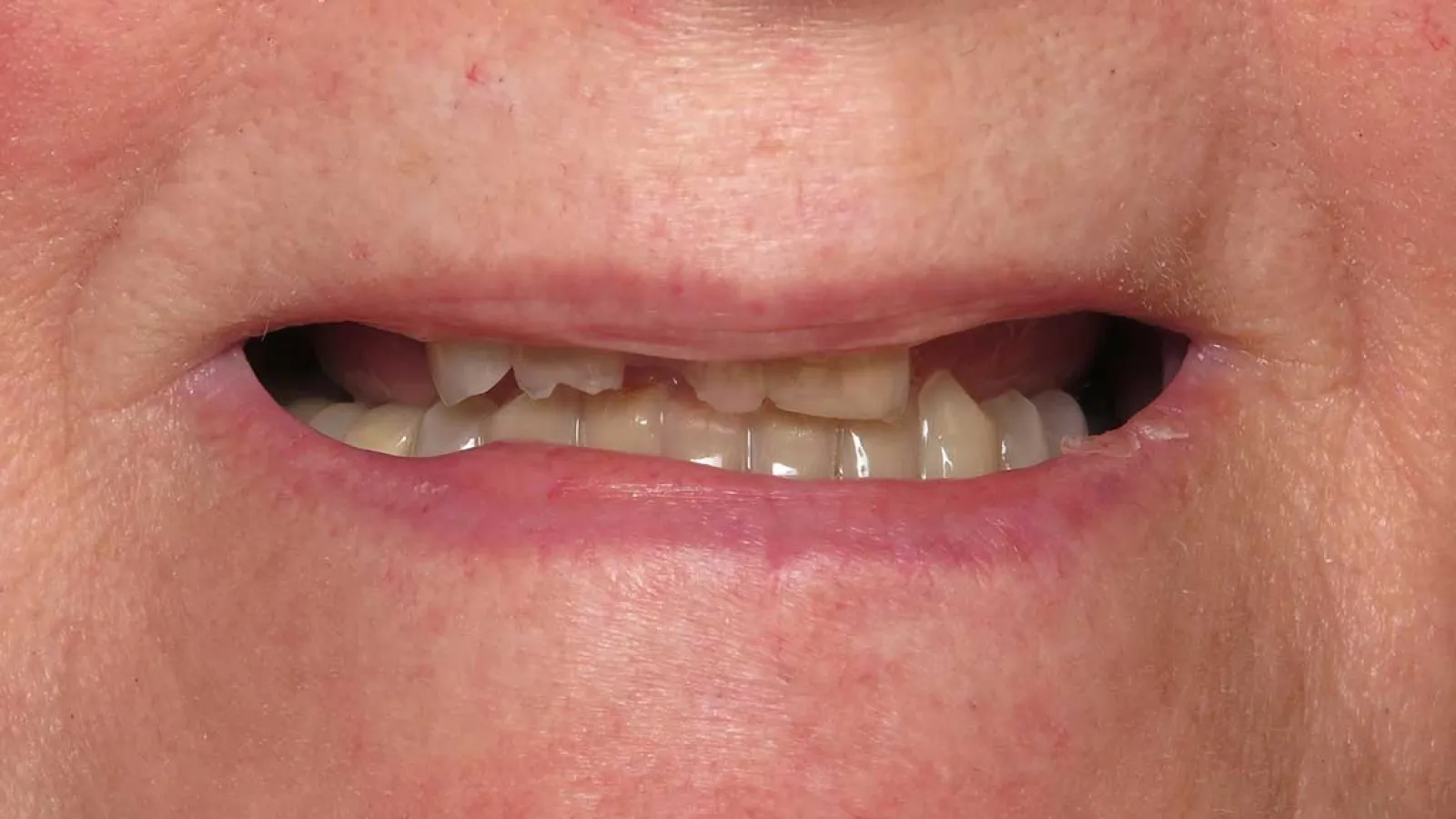 Close-up of a mouth showing uneven, discolored, and chipped teeth with visible dental issues.