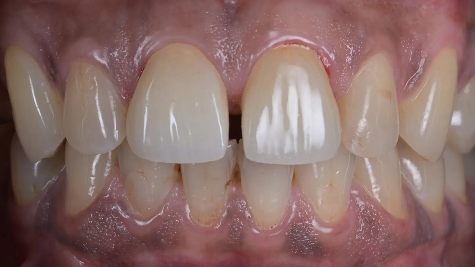 Close-up of upper and lower front teeth showing dental spacing and discoloration.