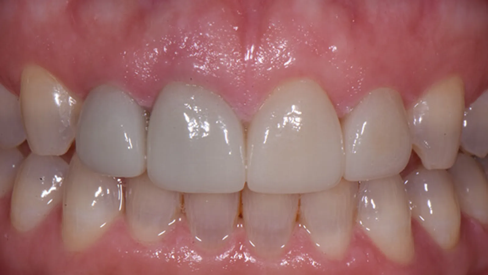 Close-up of upper and lower teeth with dental veneers showing natural and restored teeth.
