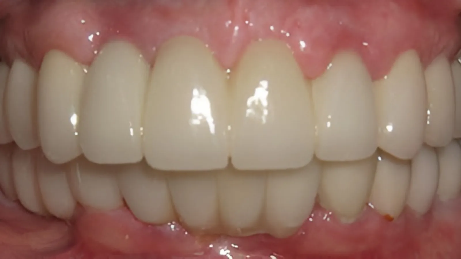 Close-up of healthy, white upper and lower teeth with natural gums in a bright smile.