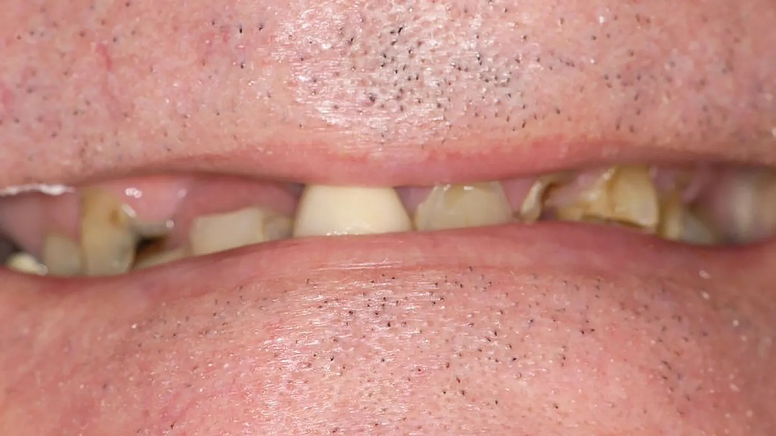 Close-up of a person's mouth showing dental issues with missing teeth and visible gum condition.