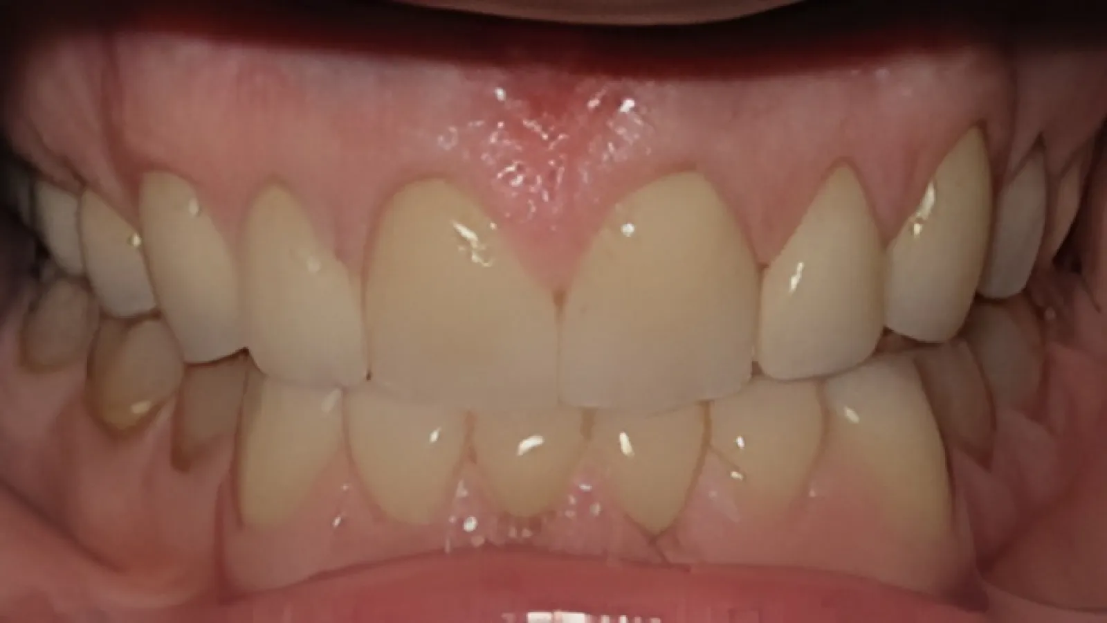 Close-up of a person's teeth showing dental alignment and gums in natural lighting.