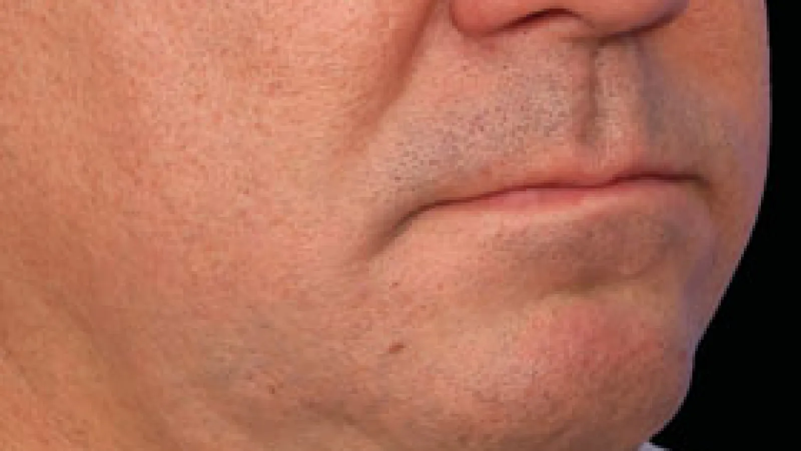 Close-up of a middle-aged man's lower face showing skin texture and slight stubble on chin and jawline.