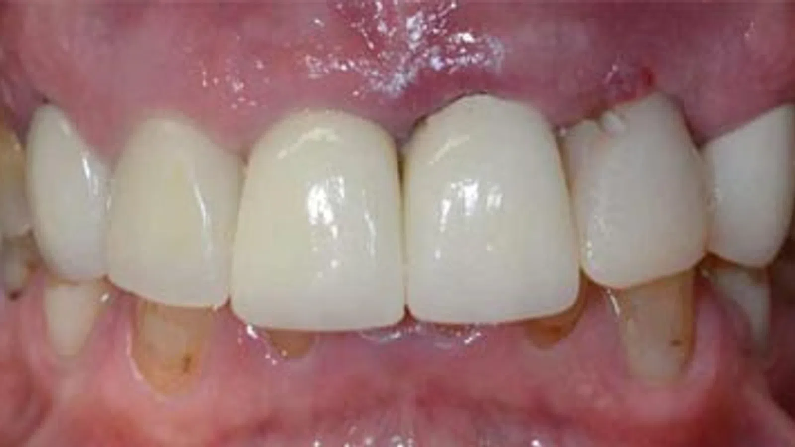 Close-up of a person's upper front teeth with dental crowns and visible gum tissue.