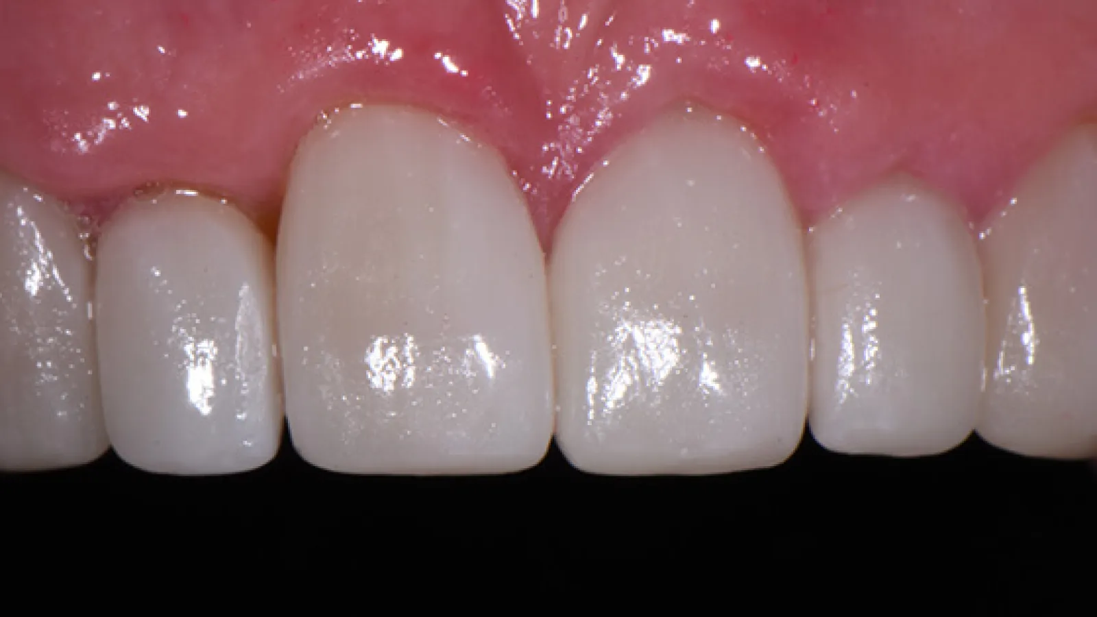 Close-up of white healthy front teeth and pink gums against a black background