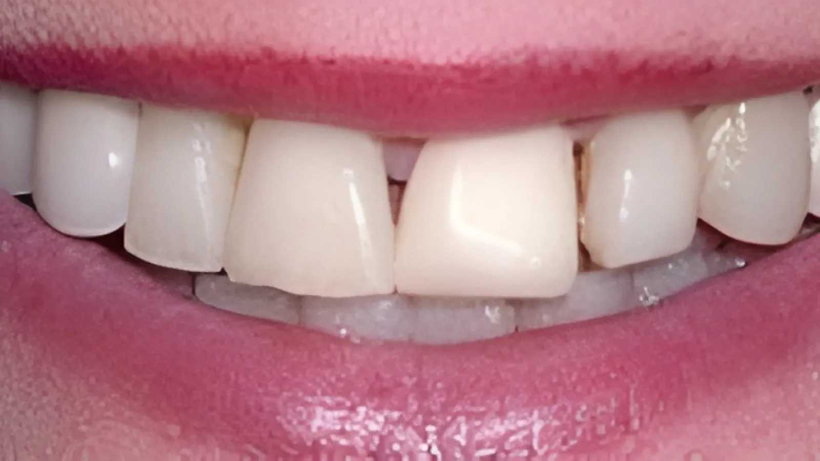 Close-up of smiling mouth showing teeth with a noticeable gap between the front teeth and pink lips.