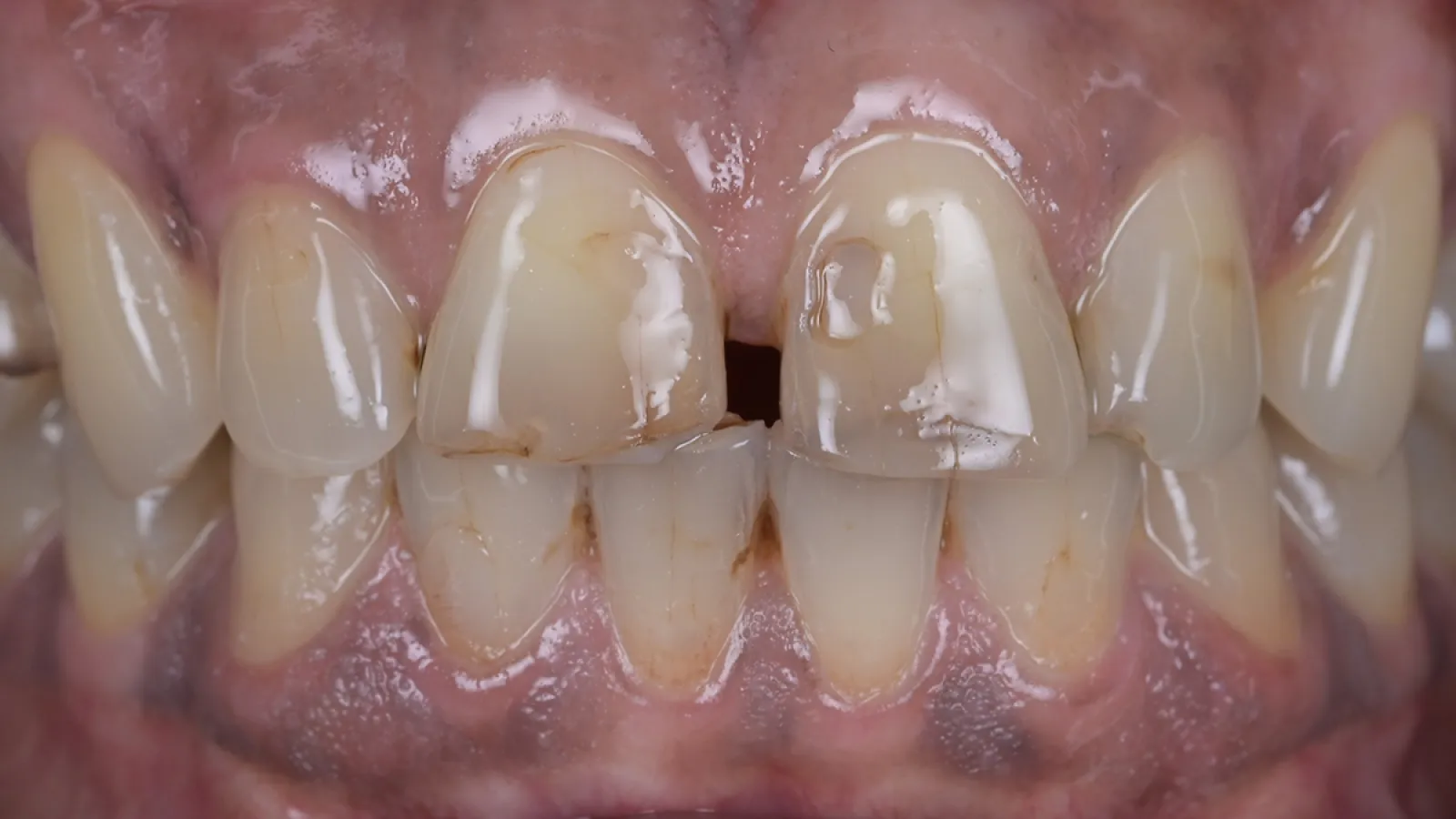 Close-up of damaged front teeth with discoloration, chipping, and plaque buildup on gums and enamel.