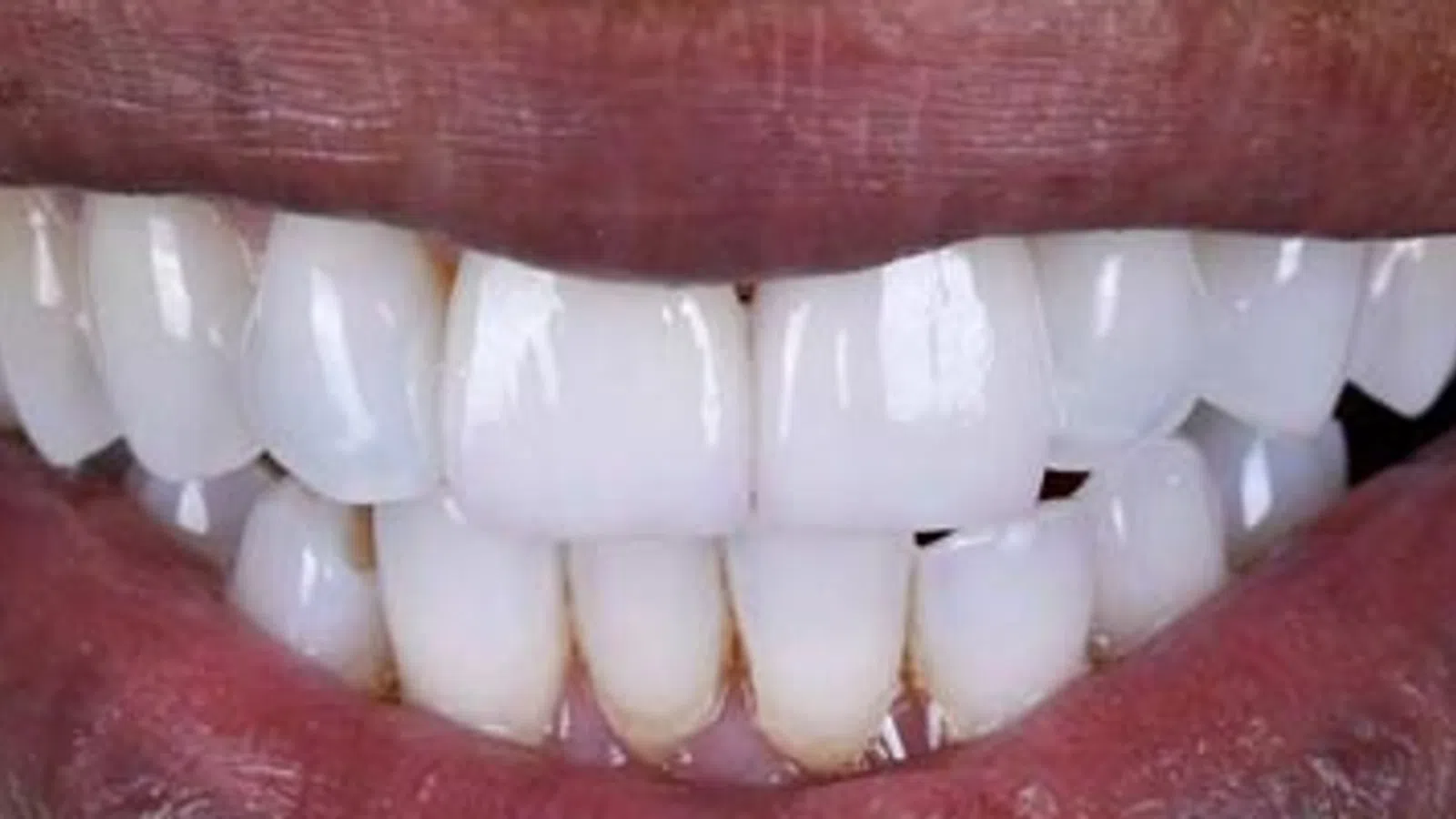 Close-up of a bright smile showing clean, white teeth and healthy pink lips.