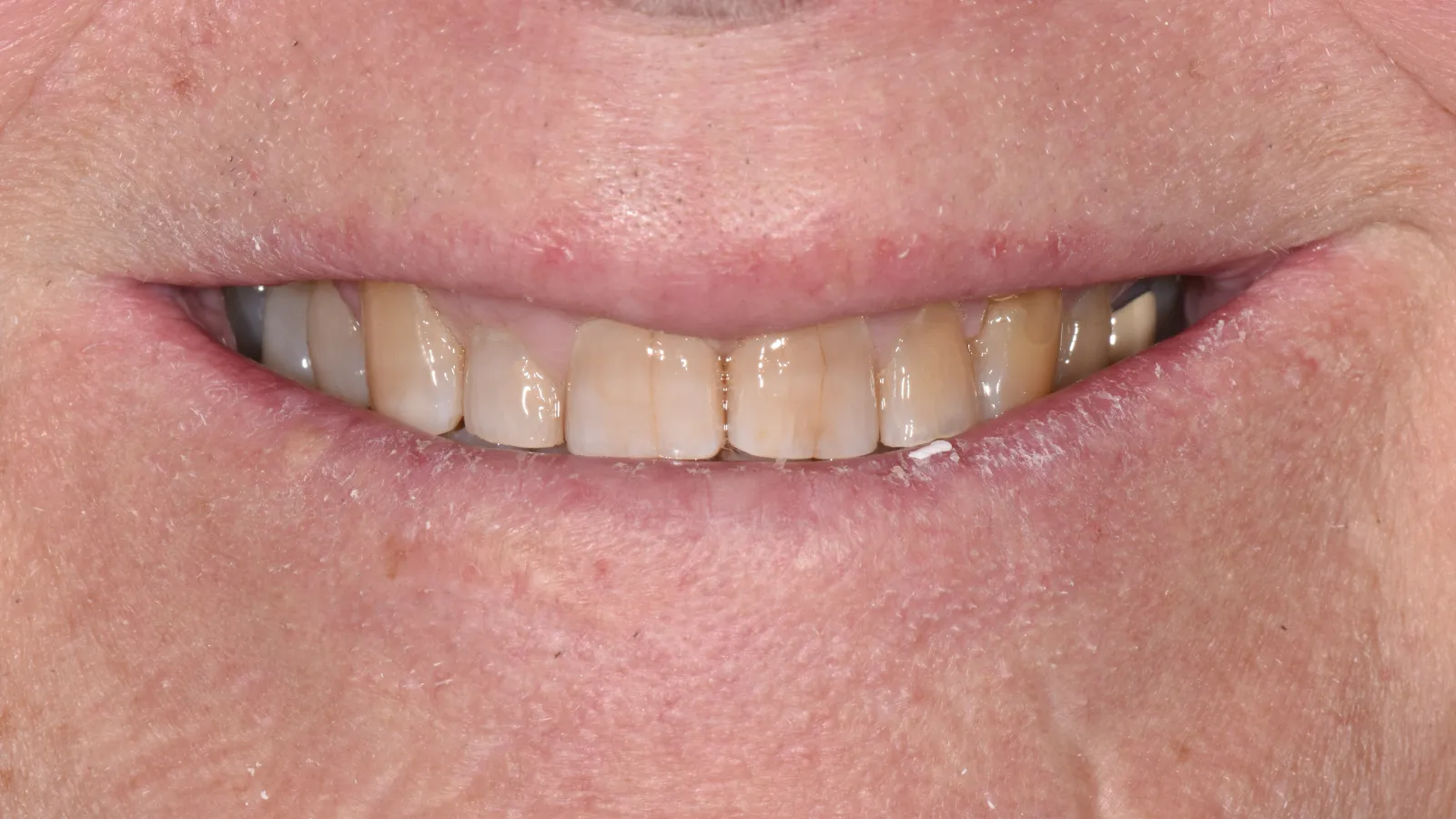 Close-up of a smile showing stained and uneven natural teeth with some discoloration and dental wear.