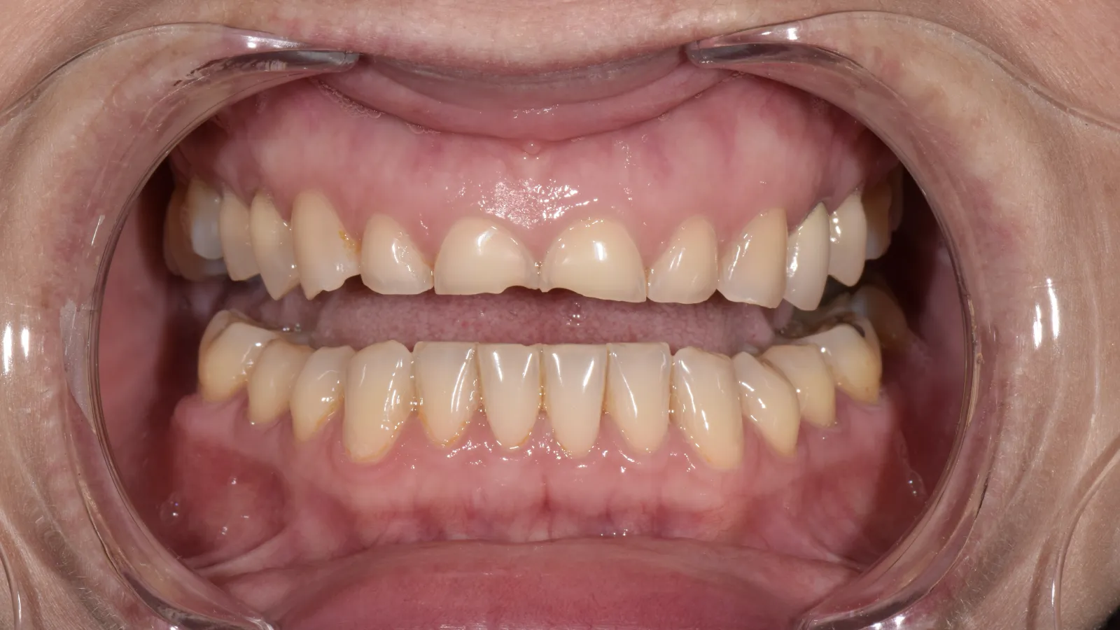 Close-up of a mouth with dental cheek retractor showing teeth with chips and discoloration.