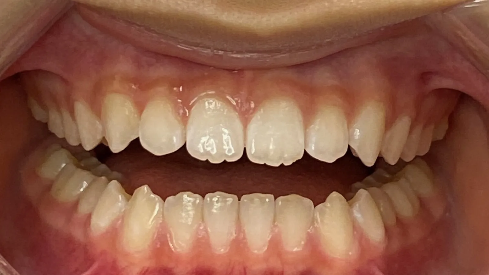 Close-up of open mouth showing natural adult teeth and healthy pink gums with slight spacing.