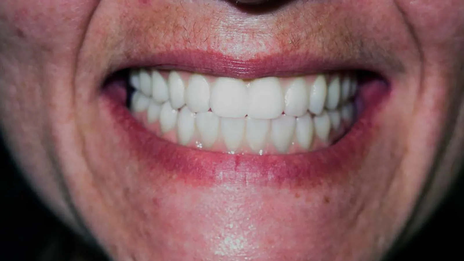 Close-up of a person's smile showing clean, white, evenly aligned teeth and lips.