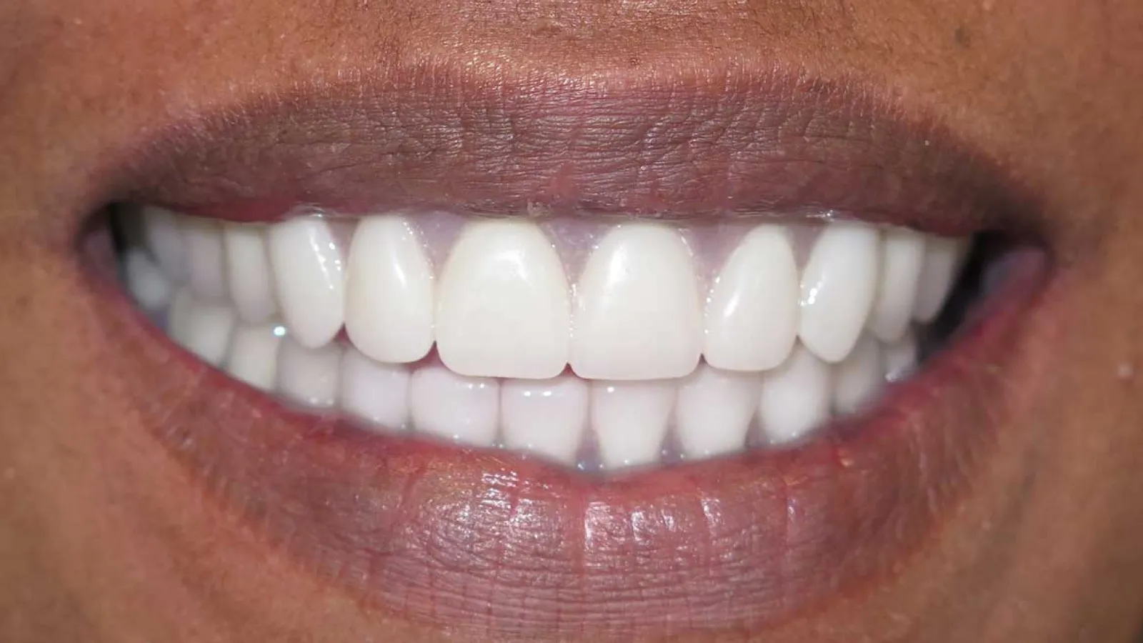 Close-up of a smiling mouth with white, healthy teeth and natural lips in soft lighting.