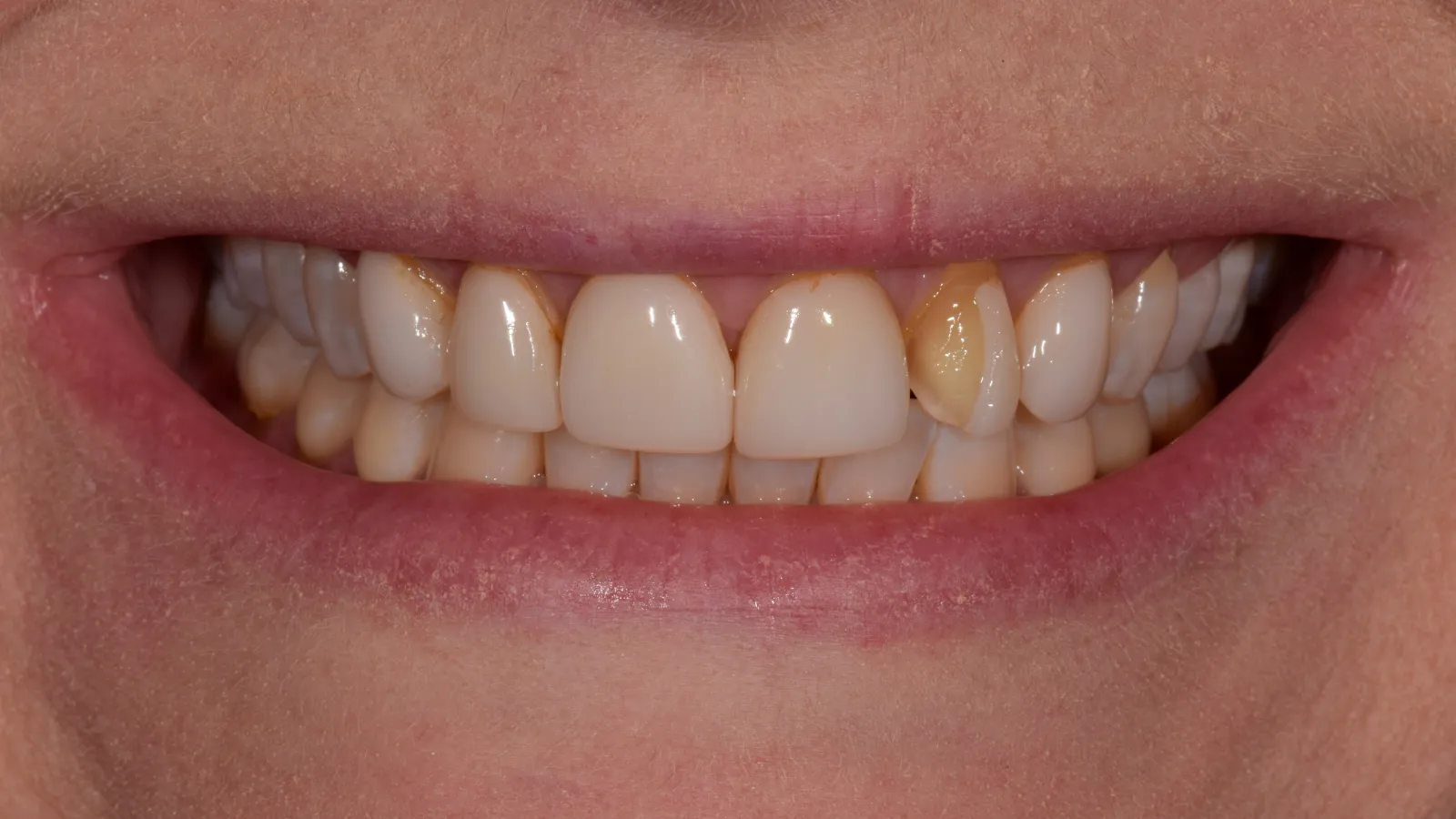 Close-up of a smiling mouth showing natural and discolored teeth with dental imperfections.