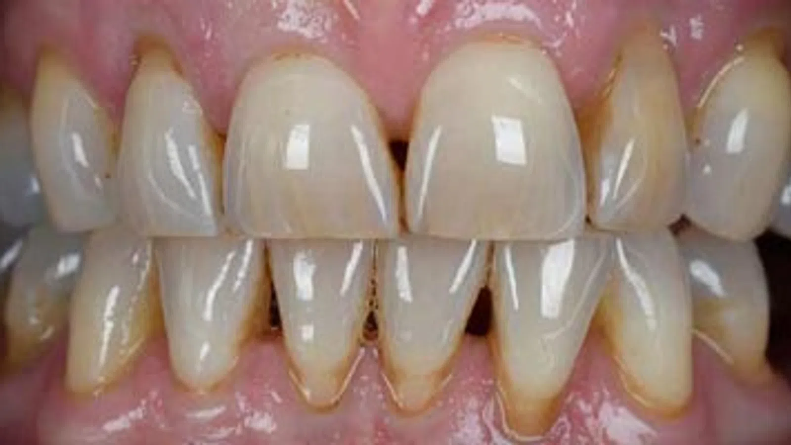 Close-up of stained and discolored lower and upper teeth with visible plaque buildup.